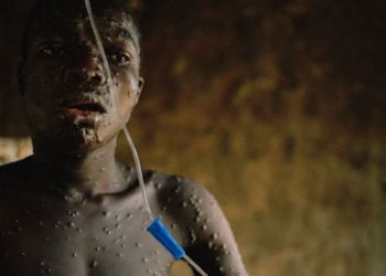 [EDITORIAL] Anxiety Over Monkeypox