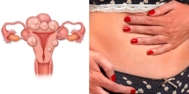 How To Prevent Death From Fibroids