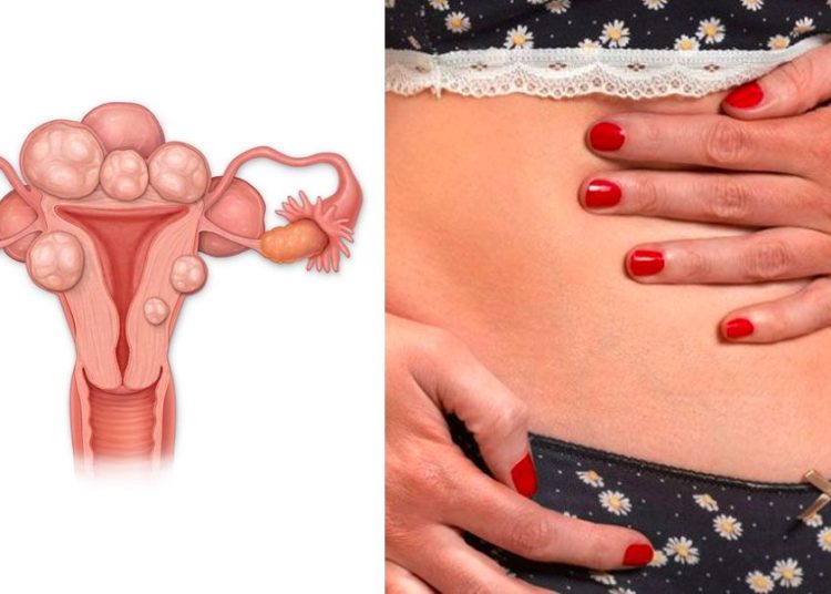 How To Prevent Death From Fibroids