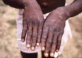 Monkeypox: US Denies Using Nigerian Labs To Spread Disease