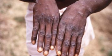 Monkeypox: US Denies Using Nigerian Labs To Spread Disease