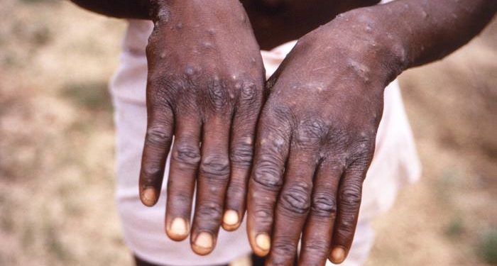 What You Should Know About Monkeypox