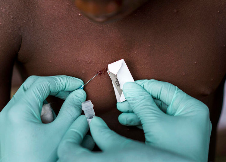 NCDC Confirms 40 Mpox Cases