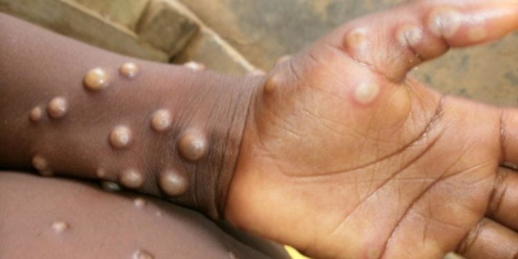 Monkeypox