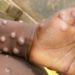 Monkey Pox: Kwara Sensitises Residents On Causes, Prevention 5 Monkeypox