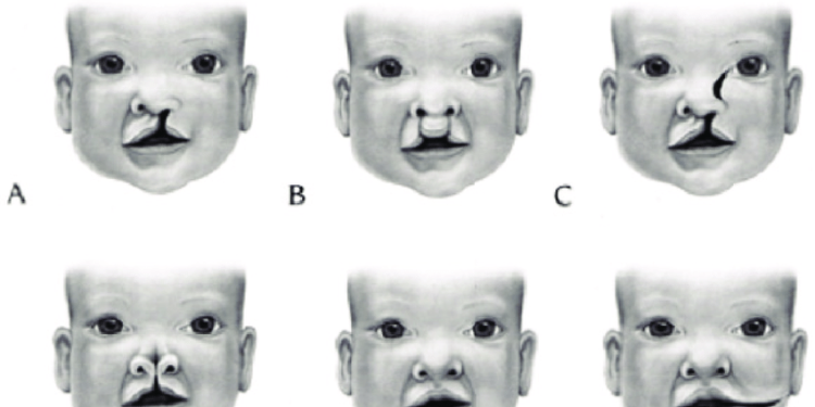 What You Should Know About Orofacial Cleft