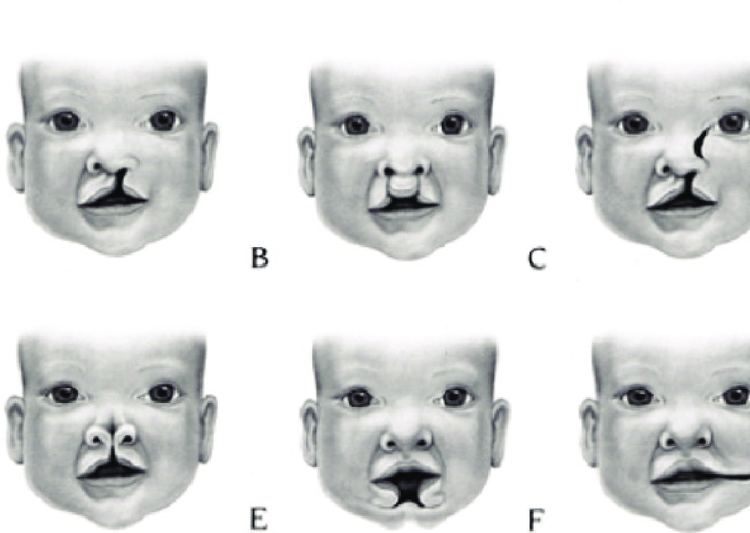 Orofacial Cleft