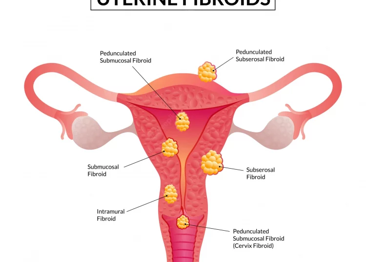 Fibroids