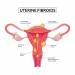 Tackling Uterine Fibroids With Modern Technology 3 Fibroids