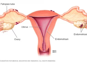 Endometriosis: An Unrecognised, Misdiagnosed Condition In Africa