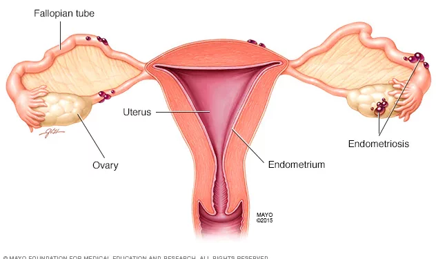 Endometriosis