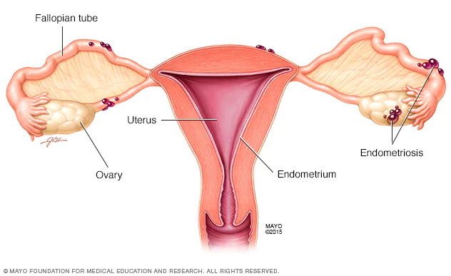 Endometriosis: An Unrecognised, Misdiagnosed Condition In Africa 1 Endometriosis