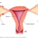 Endometriosis: An Unrecognised, Misdiagnosed Condition In Africa