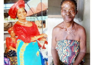 Kerosene Explosion: Widow Recounts Near-death Experience