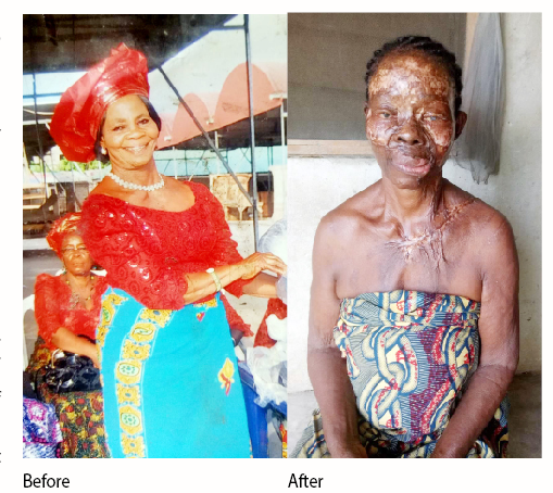 Kerosene Explosion: Widow Recounts Near-death Experience 1 widow