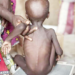 Lagos And Its Bid To End Malnutrition 5 Lagos And Its Bid To End Malnutrition