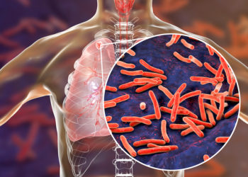 Governors Tasked On Tuberculosis Scourge
