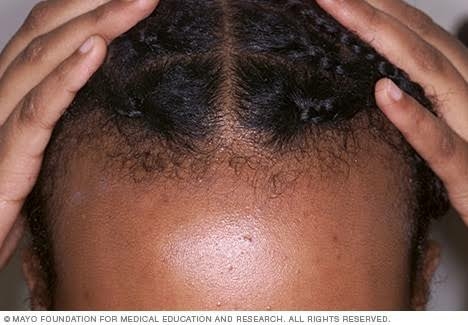 Hair Loss Awareness Month: Your Condition Shouldn’t Define You – Otubanjo 1 hair