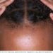 Hair Loss Awareness Month: Your Condition Shouldn’t Define You – Otubanjo 
