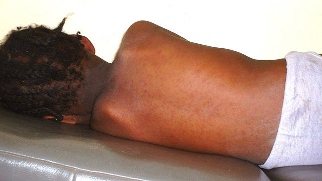 Measles: 190 Children Killed As Cases Hit 18,577 In 36 States, FCT 1 measles
