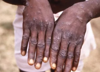 Benue Records 10 Cases Of Monkeypox