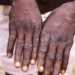 Benue Records 10 Cases Of Monkeypox