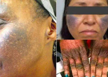 Despite Health Hazards, Bleaching Creams Remain Top Taste For Nigerian Women