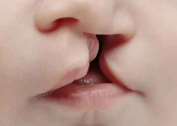 What You Need To Know About Orofacial Cleft