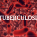 Anambra Records 26,000 TB Cases In 3 Months
