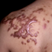 How To Treat Keloids 5 How To Treat Keloids