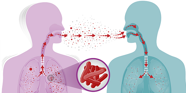 Tuberculosis In Children, How To Prevent It 1 TB