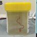 Live Parasitic Worm Found In Woman’s Brain In World First 3 Live Parasitic Worm Found In Woman’s Brain In World First