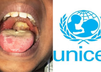 Diphtheria Killed 122 In Nigeria – UNICEF