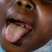 Diphtheria Kills 10 Children In Jigawa, 91 Cases Reported