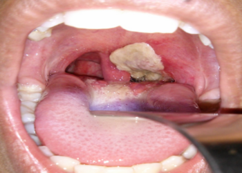 Diphtheria: Vaccination As Most Effective Prevention