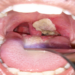 Diphtheria: Vaccination As Most Effective Prevention 5 Diphtheria: Vaccination As Most Effective Prevention