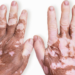 Vitiligo: Understanding A Skin Disorder 5 Vitiligo: Understanding A Skin Disorder