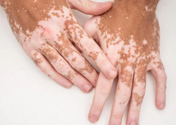 Living With Vitiligo