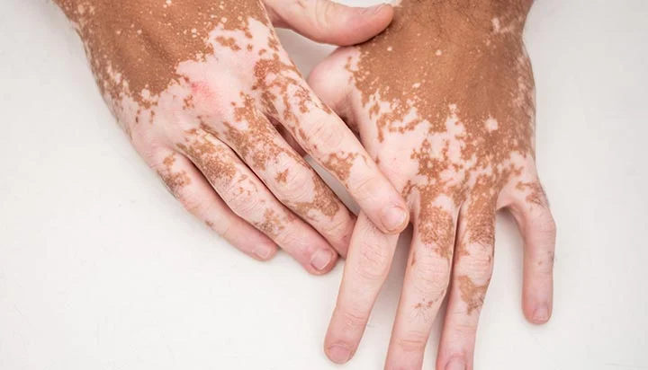 Living With Vitiligo 1 Vitiligo