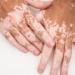 Living With Vitiligo 5 Living With Vitiligo
