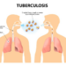 Kano Detects Highest Number Of Tuberculosis Cases In Nigeria
