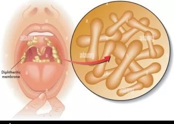 Diphtheria Outbreak Claims Four Lives In Nasarawa 