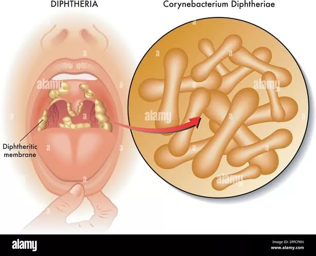 Diphtheria Outbreak Claims Four Lives In Nasarawa 1 Diptheria jpeg