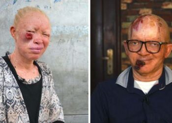 Skin Cancer Cases Increase Among Albinos in Kaduna