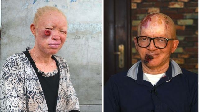 Skin Cancer Cases Increase Among Albinos in Kaduna 1 IMG 3600