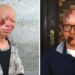 Skin Cancer Cases Increase Among Albinos in Kaduna
