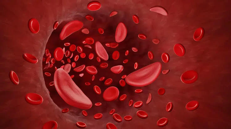 US Agency Approves Cure For Sickle Cell Disease 1 images 13 1 jpeg