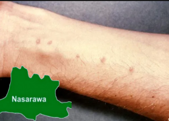 Nasarawa Treats 398,798 Children Of Schistosomiasis