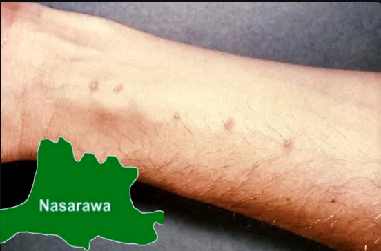 Nasarawa Treats 398,798 Children Of Schistosomiasis 1 Schito 1