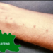 Nasarawa Treats 398,798 Children Of Schistosomiasis 5 Nasarawa Treats 398,798 Children Of Schistosomiasis